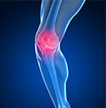 knee osteoarthritis