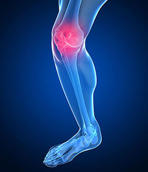 knee osteoarthritis